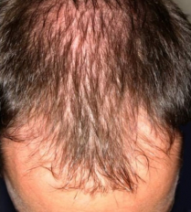 HAIR CARE AND HOMOEOPATHY
